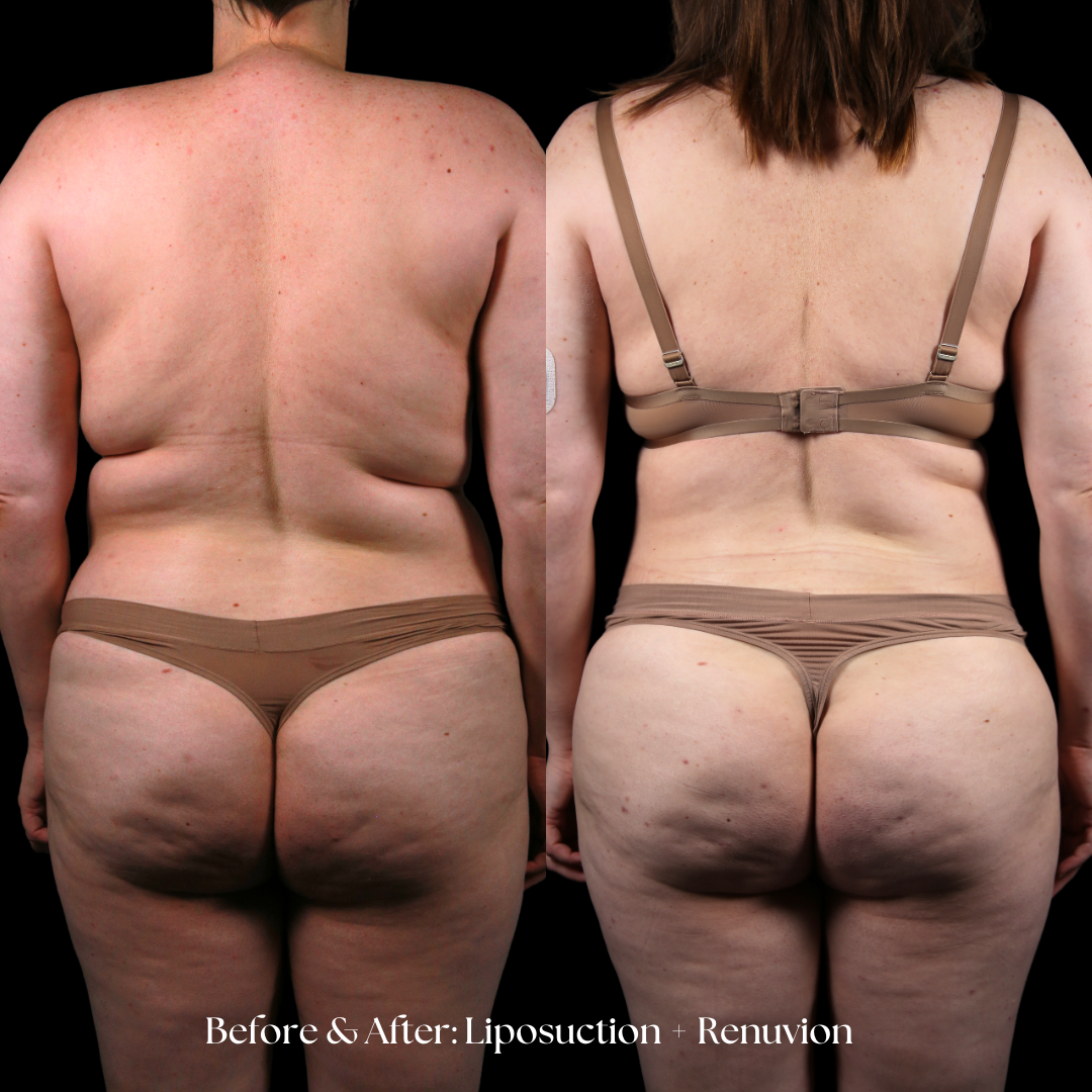 Liposuction  Before & After