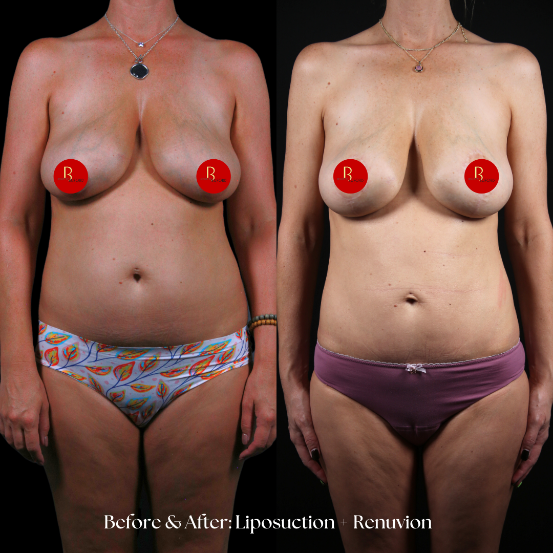 Liposuction  Before & After