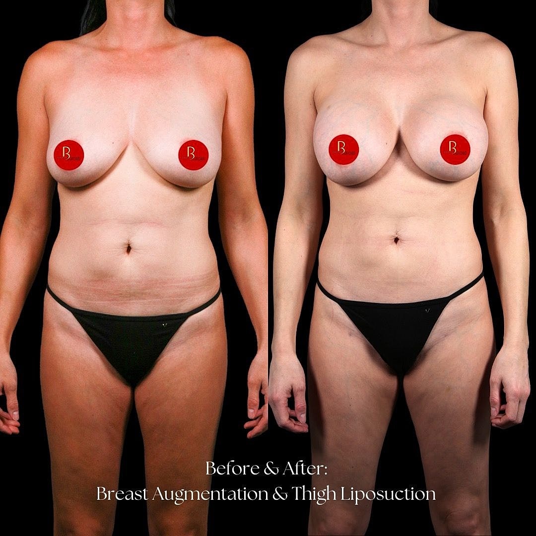 Breast augmentation and thigh liposuction before and after