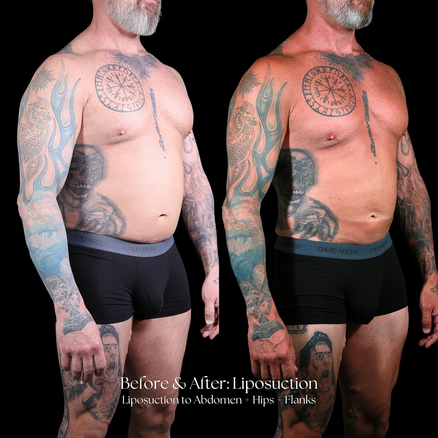 Liposuction  Before & After