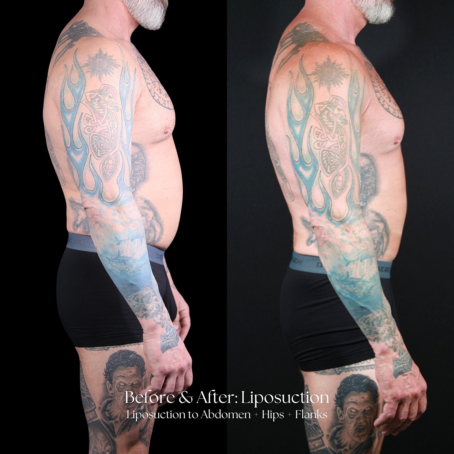 Liposuction  Before & After