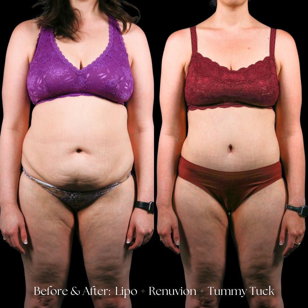 Renuvion Before & After