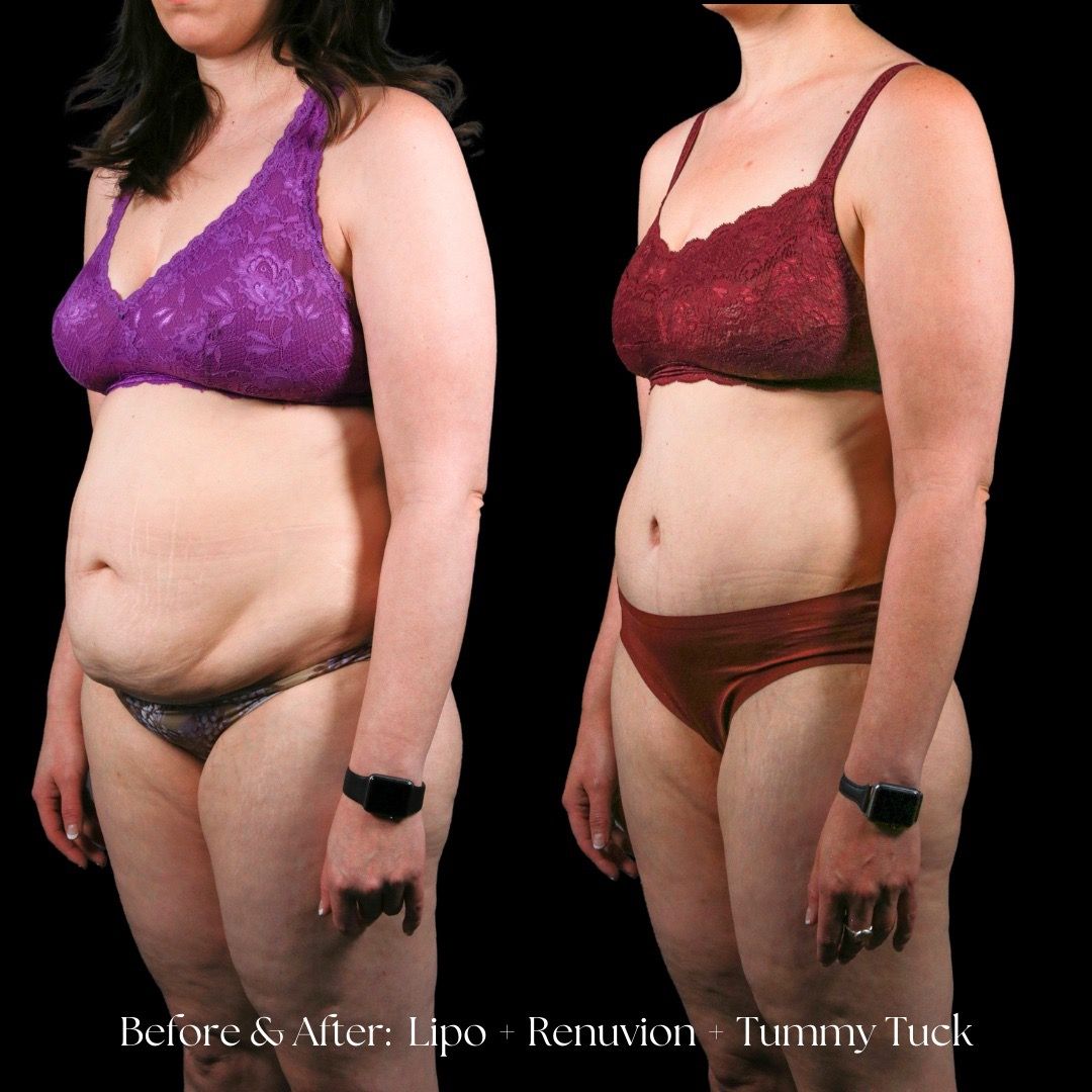 Renuvion Before & After