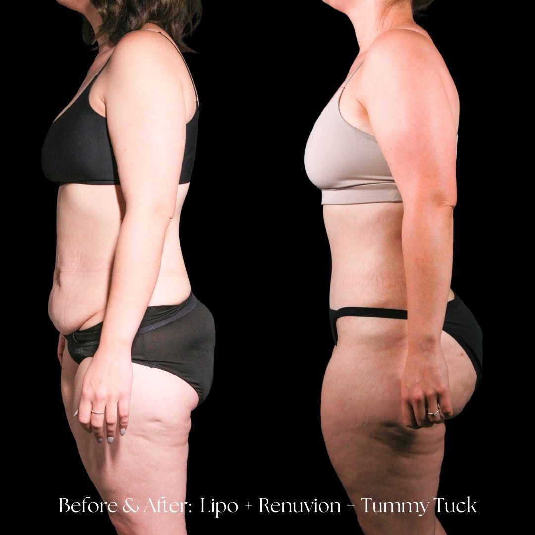 Renuvion Before & After