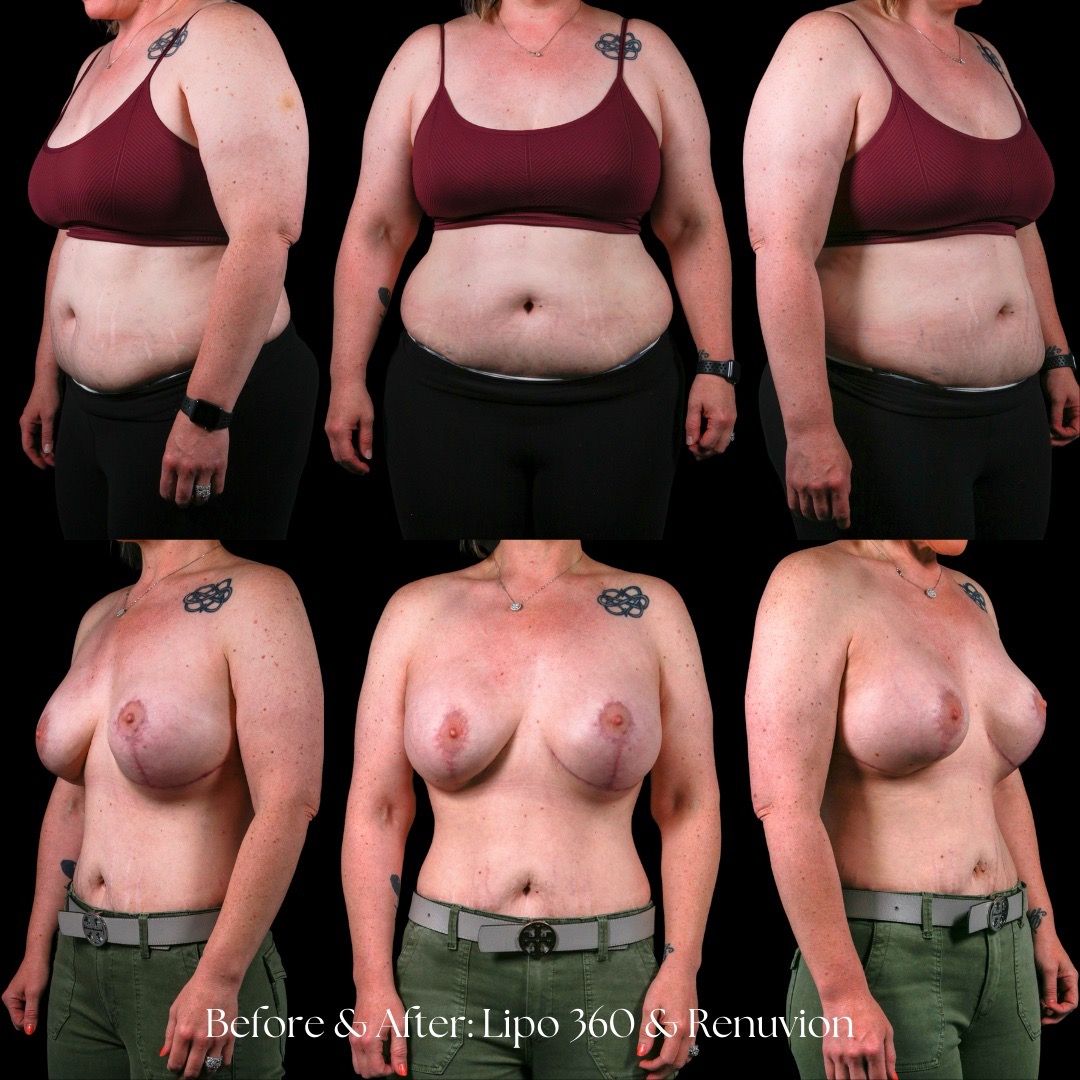 Renuvion Before & After