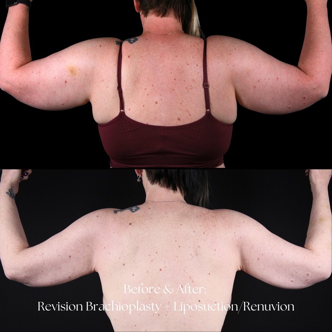 Renuvion Before & After