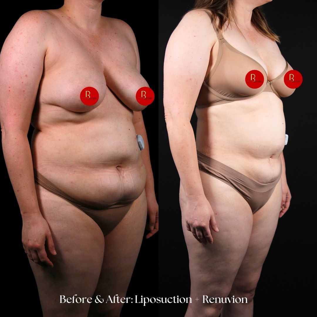 Renuvion Before & After