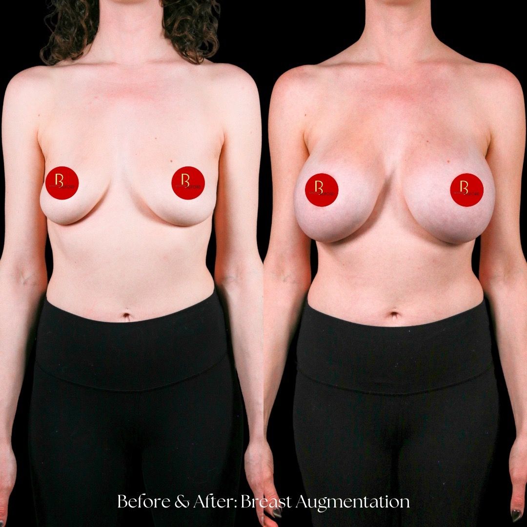 Breast Augmentation Before & After