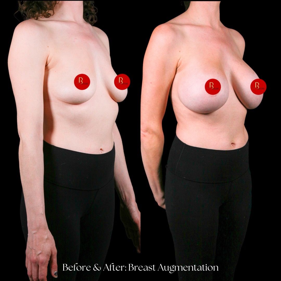 Breast Augmentation Before & After