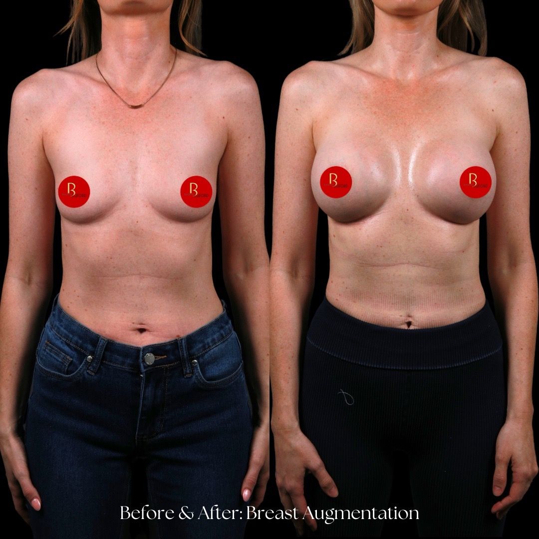 Breast Augmentation Before & After