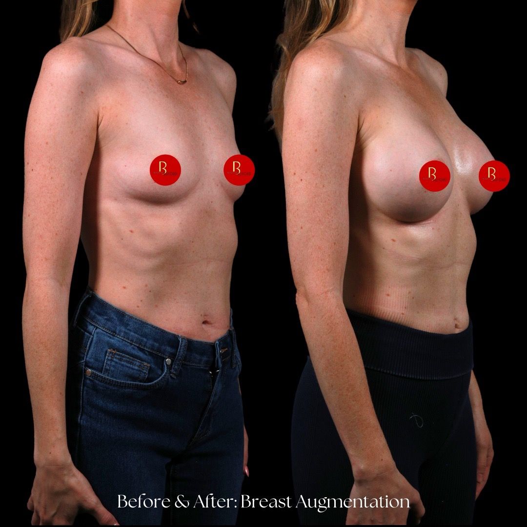 Breast Augmentation Before & After