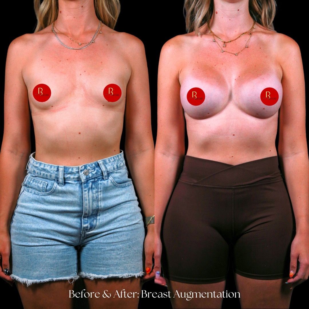 Breast Augmentation Before & After