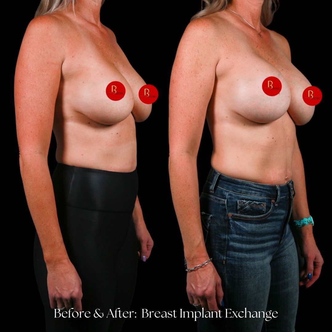 Breast Augmentation Before & After