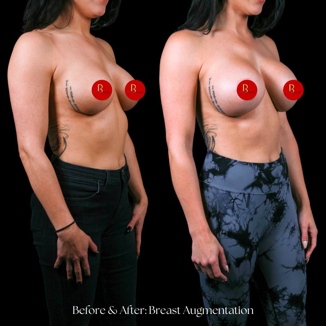 Breast Augmentation Before & After