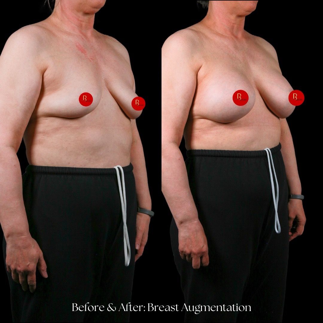 Breast Augmentation Before & After