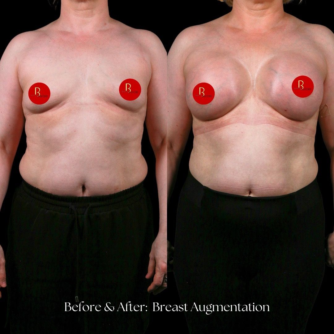 Breast Augmentation Before & After