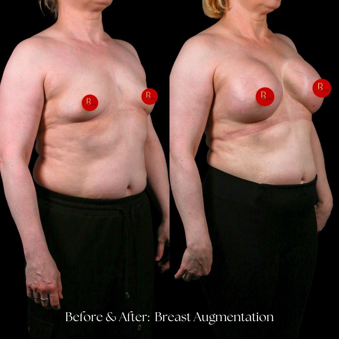 Breast Augmentation Before & After