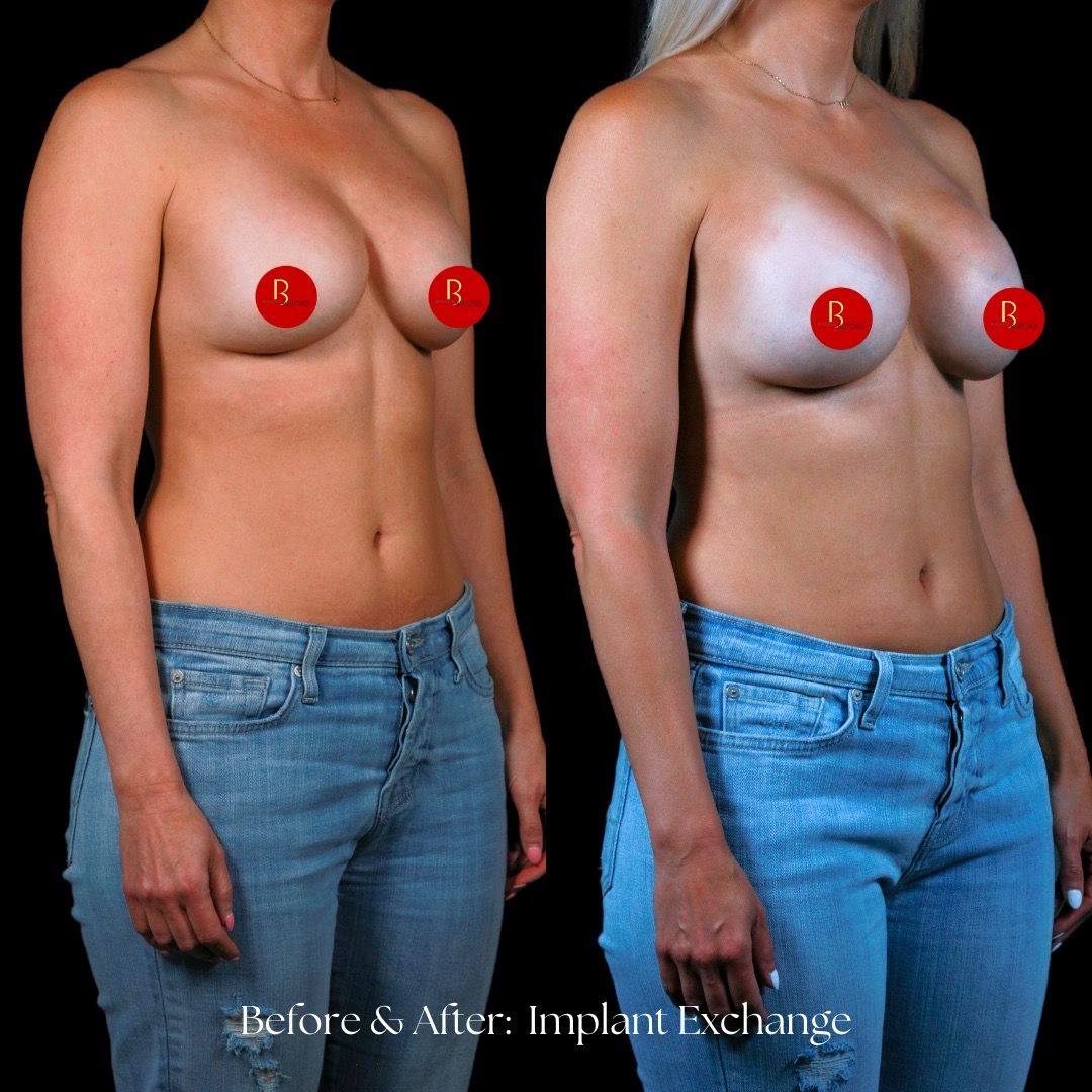 Breast Augmentation Before & After