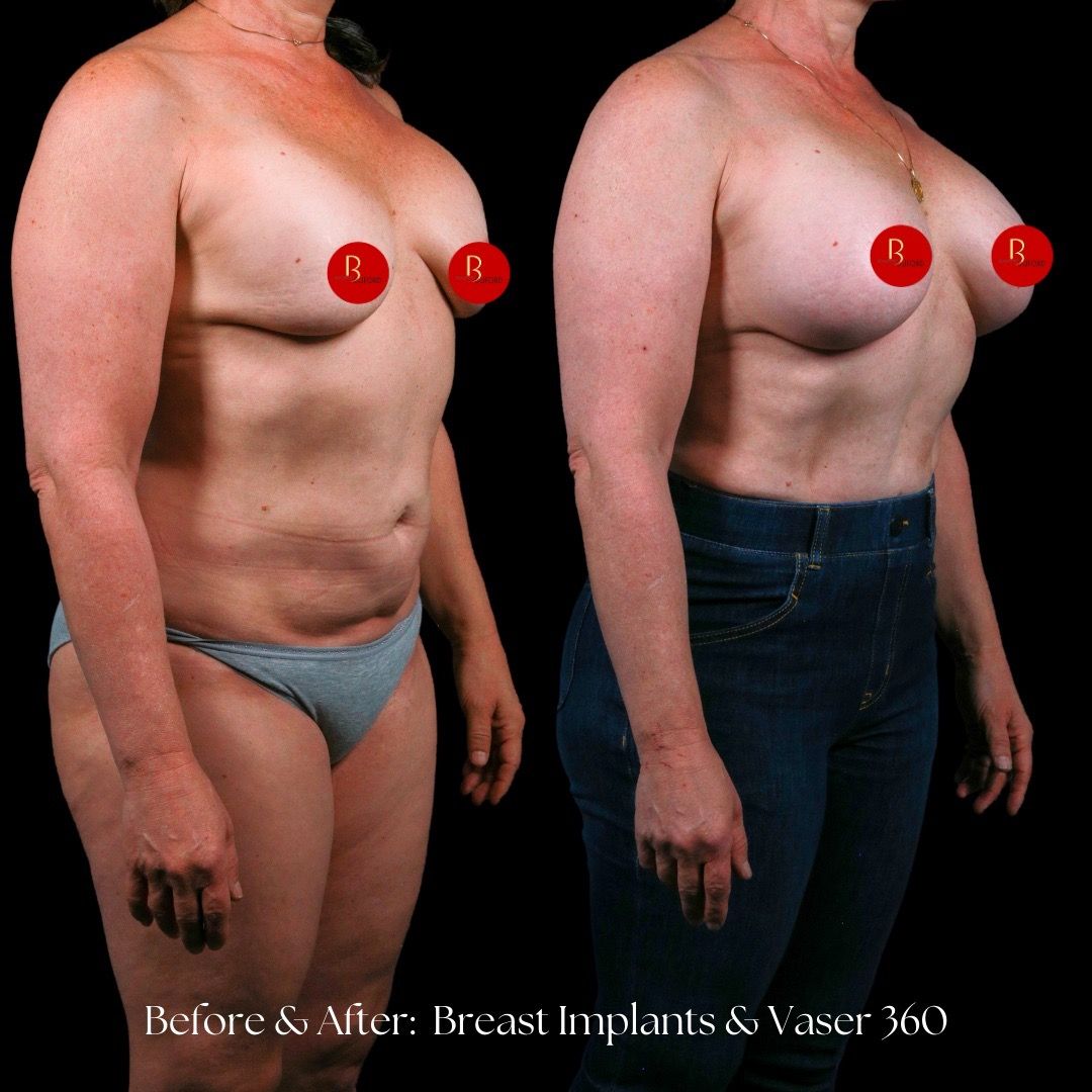 Breast Augmentation Before & After