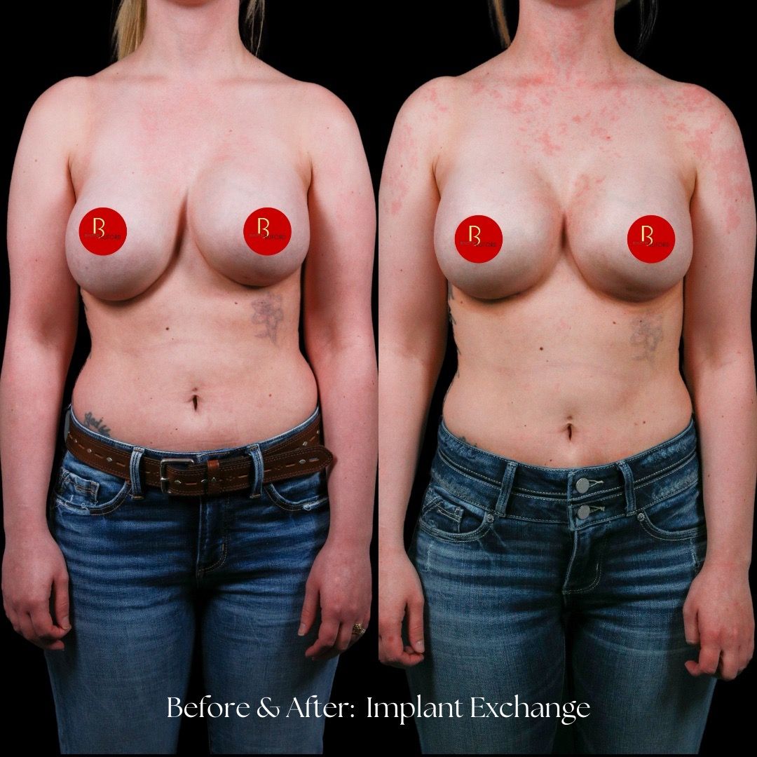 Breast Augmentation Before & After