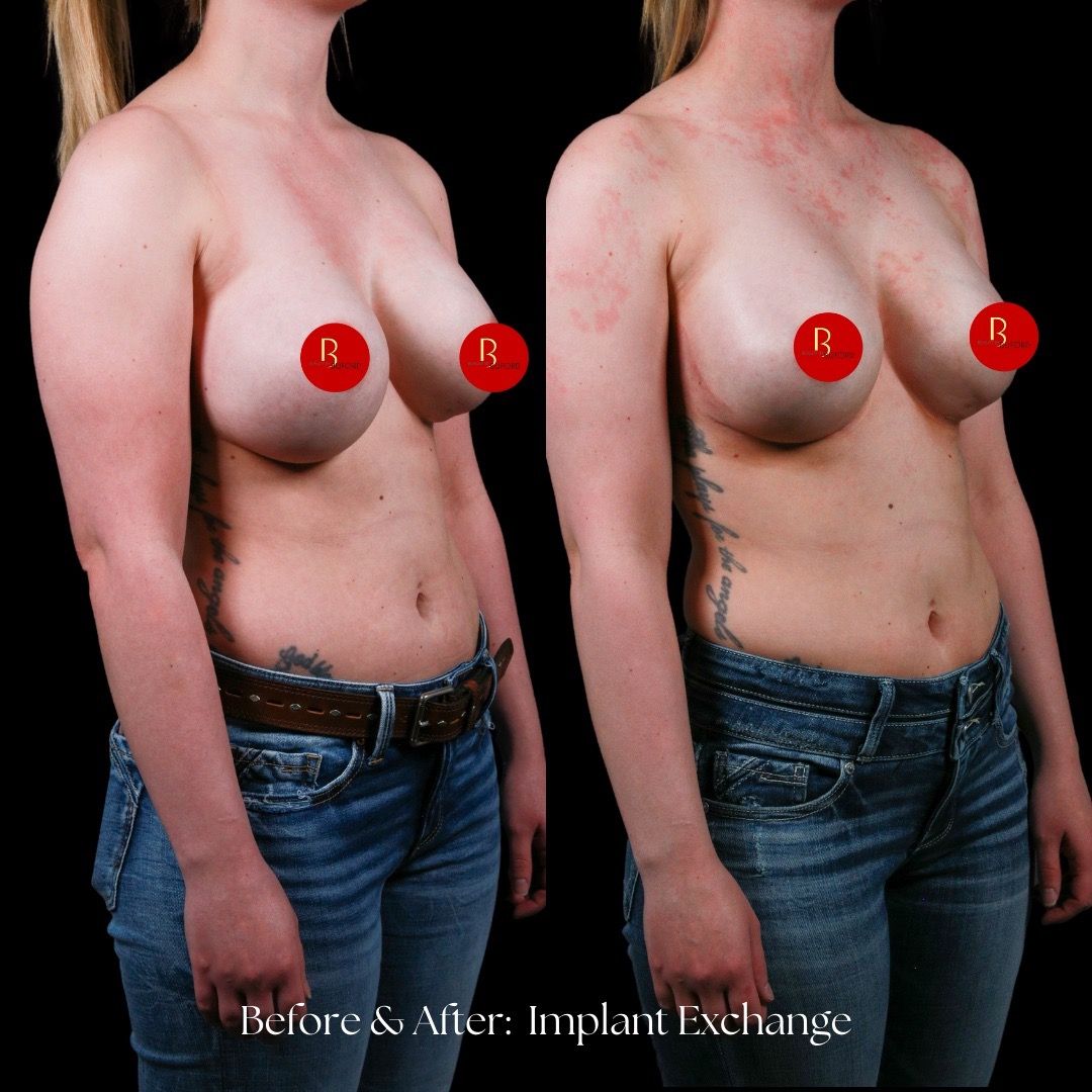 Breast Augmentation Before & After