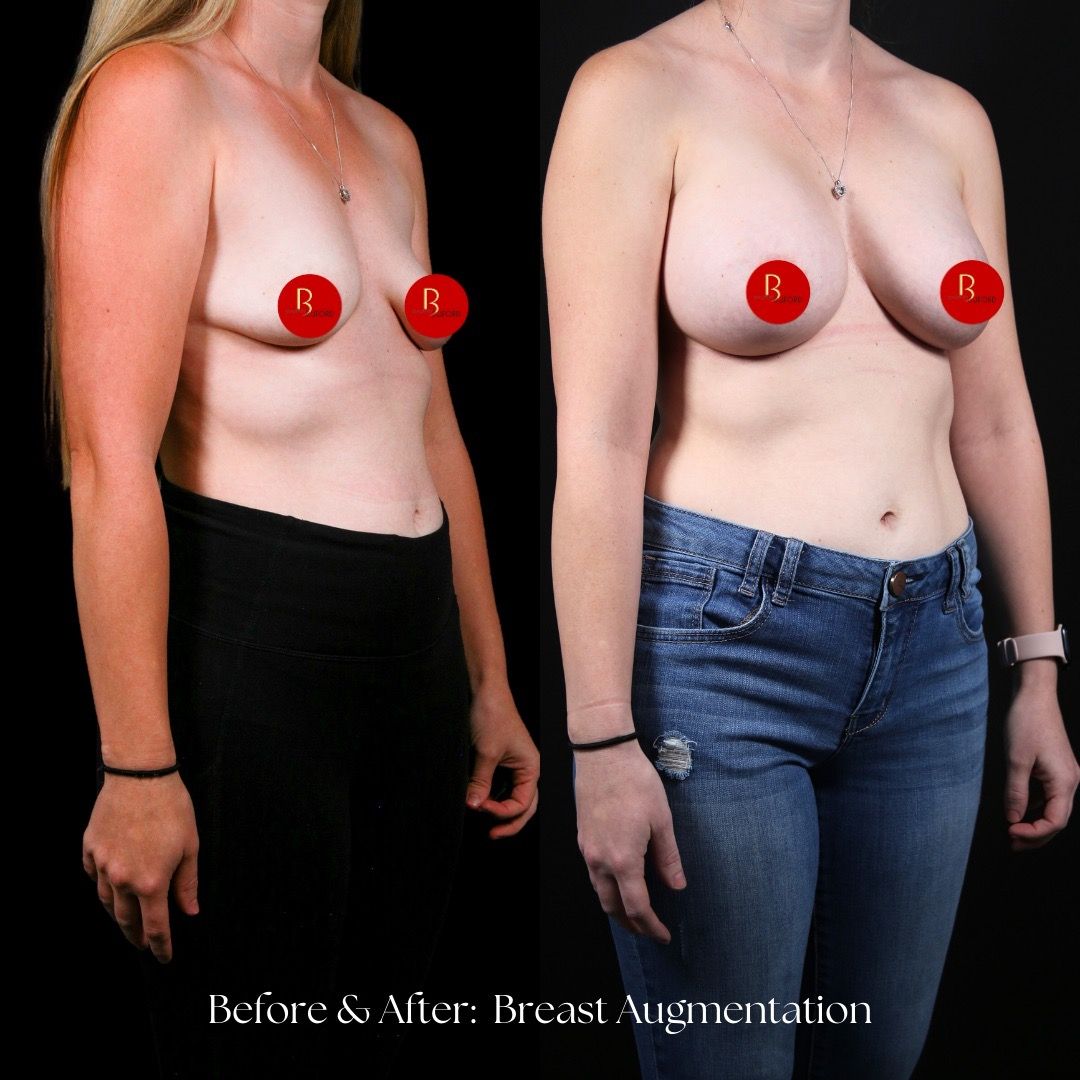 Breast Augmentation Before & After