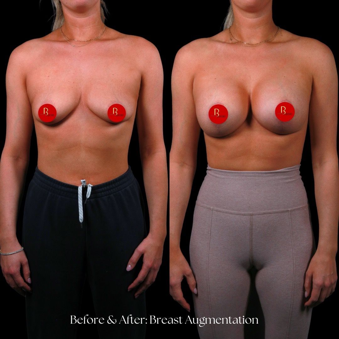 Breast Augmentation Before & After