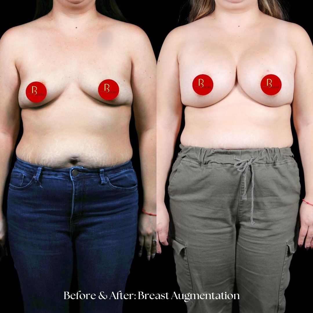Breast Augmentation Before & After
