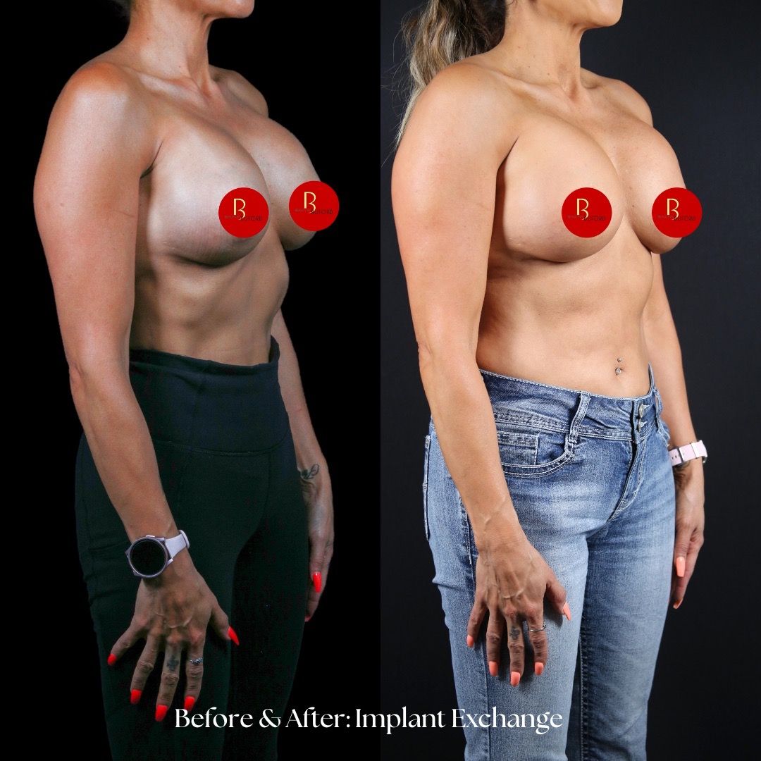 Breast Augmentation Before & After
