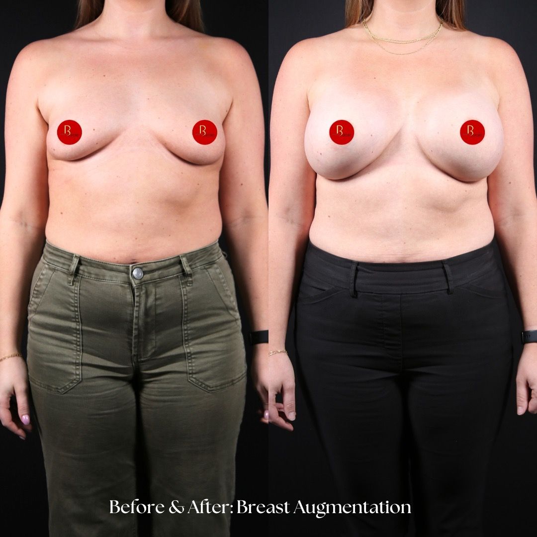 Breast Augmentation Before & After
