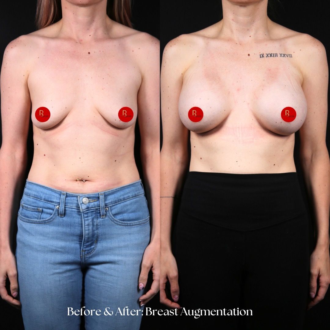Breast Augmentation Before & After