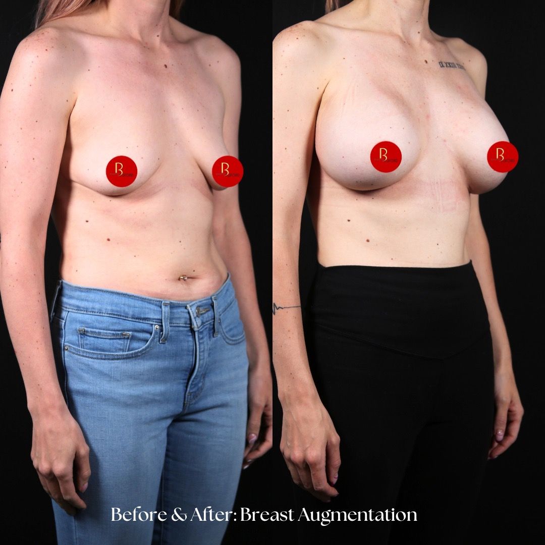 Breast Augmentation Before & After