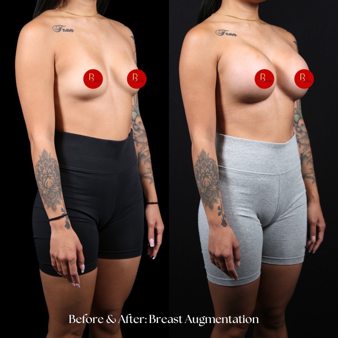 Breast Augmentation Before & After