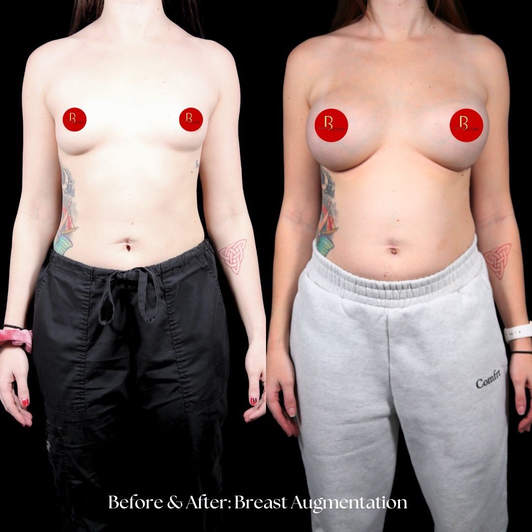 Breast Augmentation Before & After