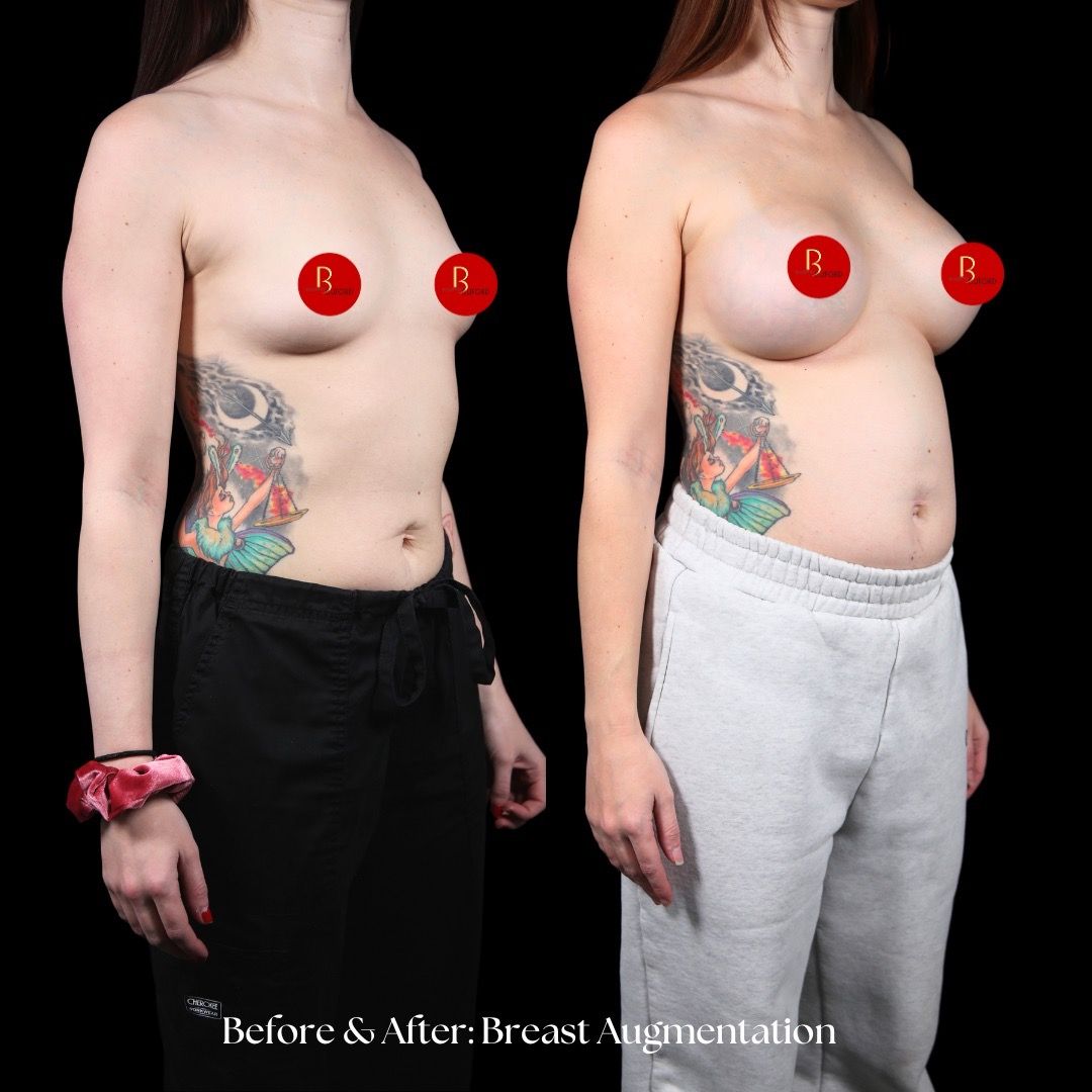 Breast Augmentation Before & After