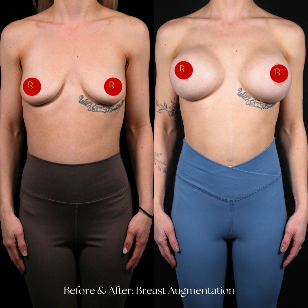 Breast Augmentation Before & After
