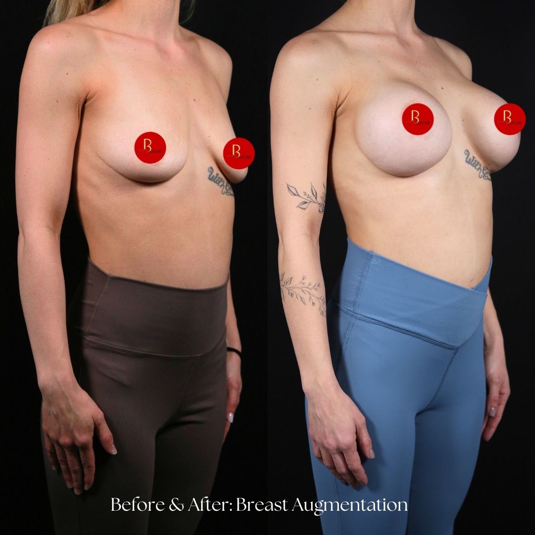 Breast Augmentation Before & After