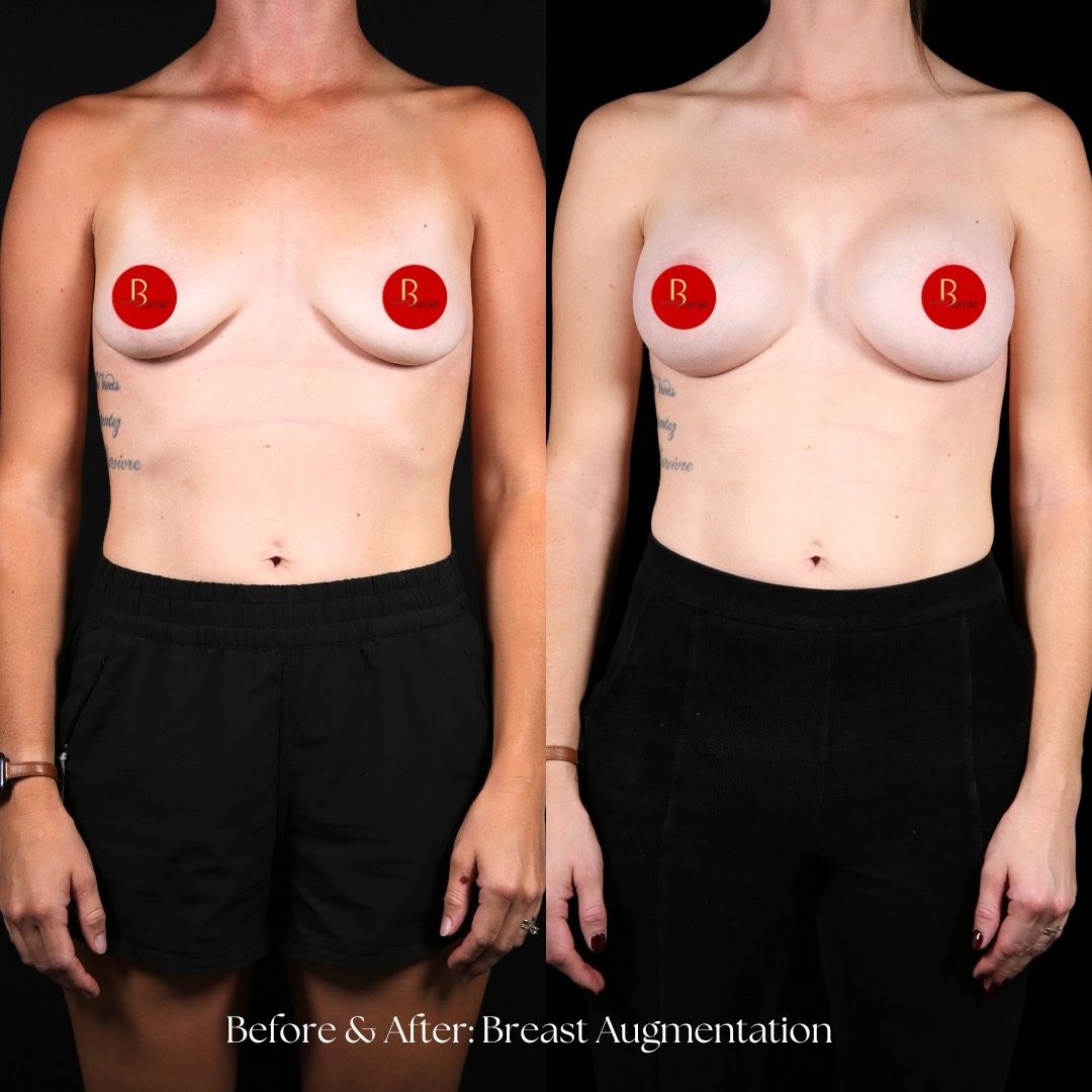 Breast Augmentation Before & After