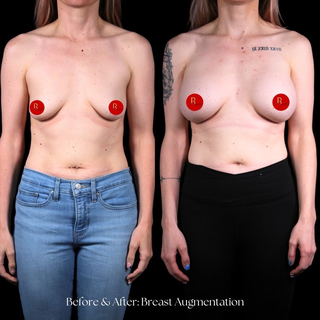 Breast Augmentation Before & After