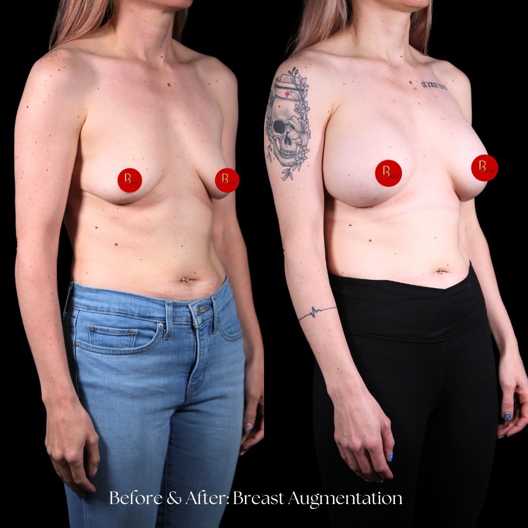 Breast Augmentation Before & After