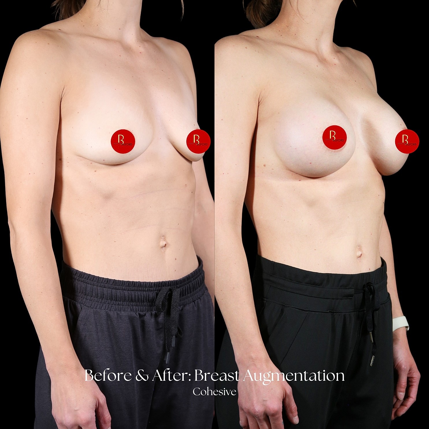 Breast Augmentation Before & After