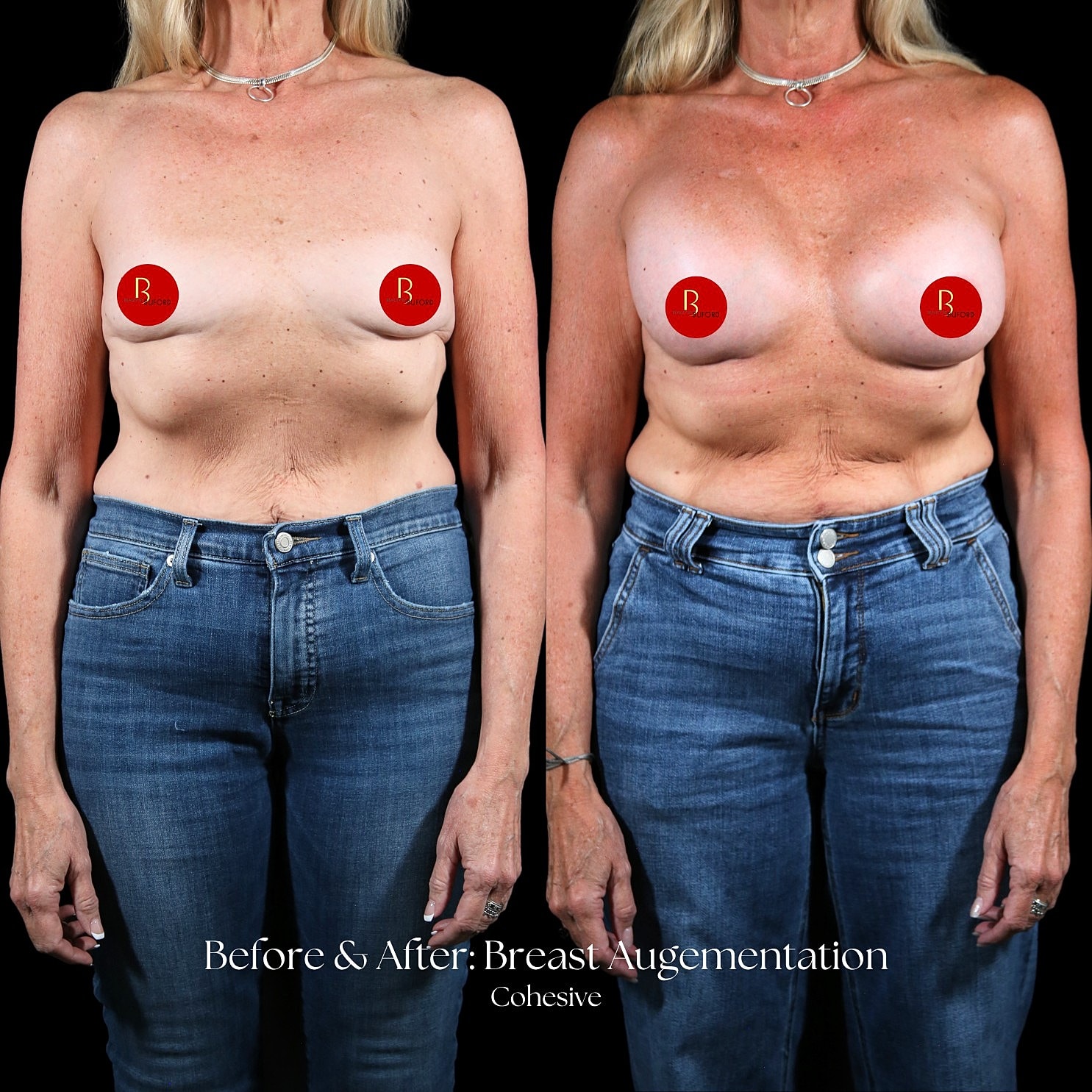 Breast Augmentation Before & After