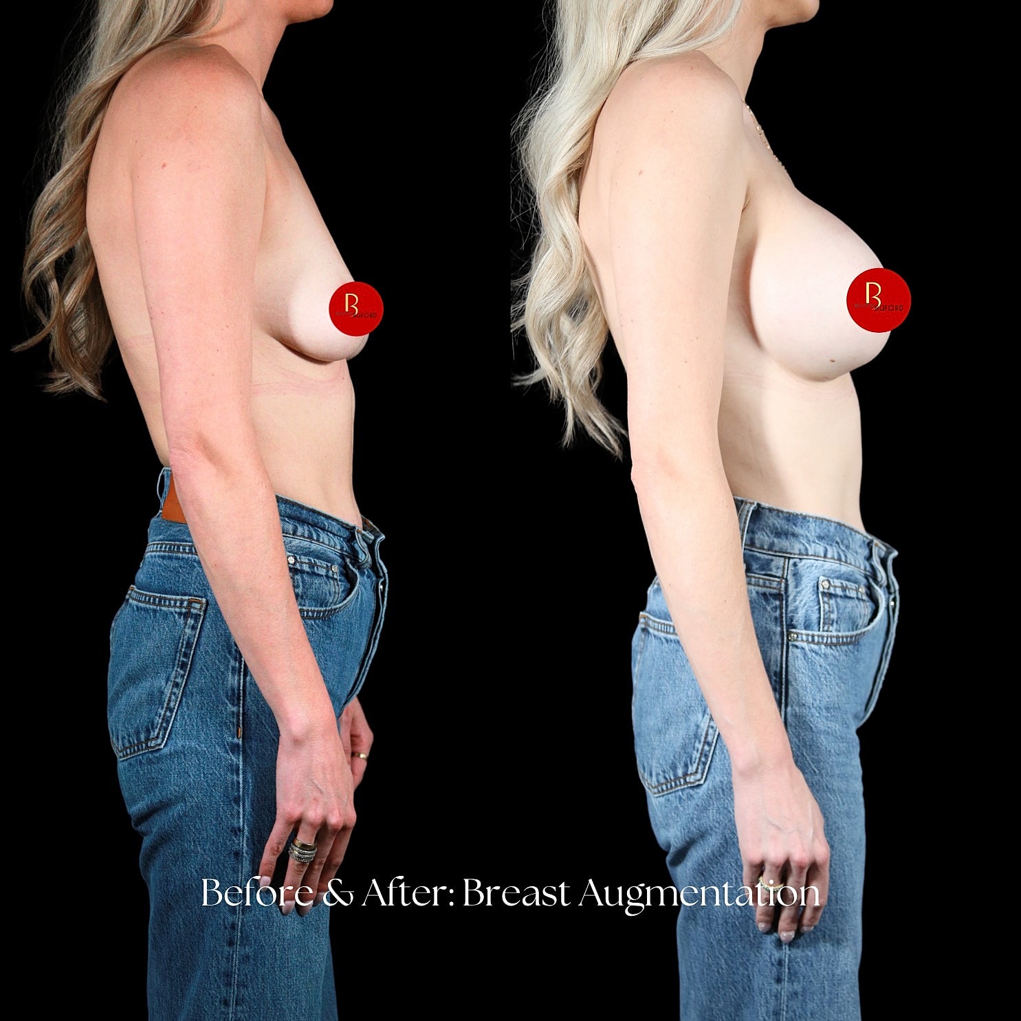 Breast Augmentation Before & After