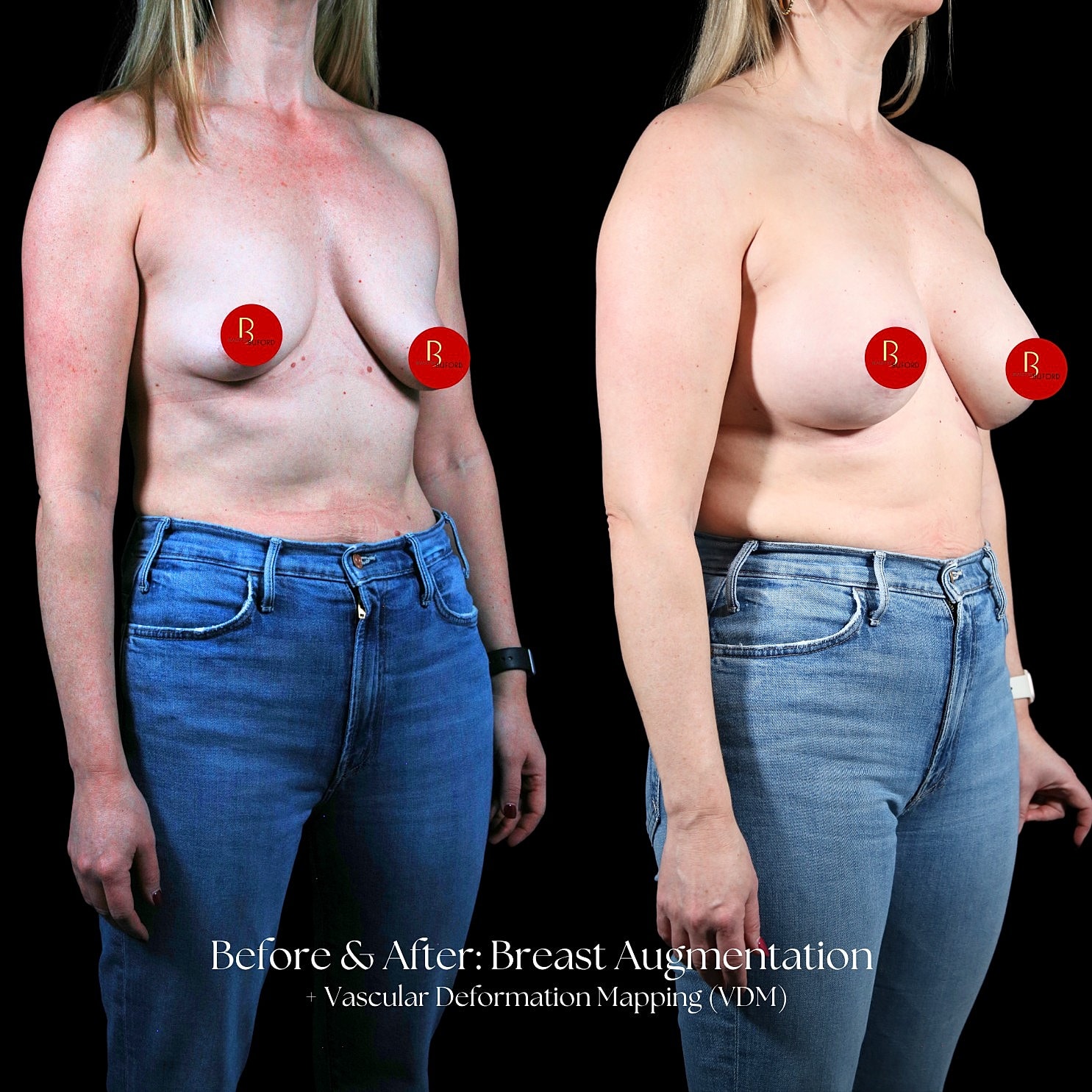 Breast Augmentation Before & After
