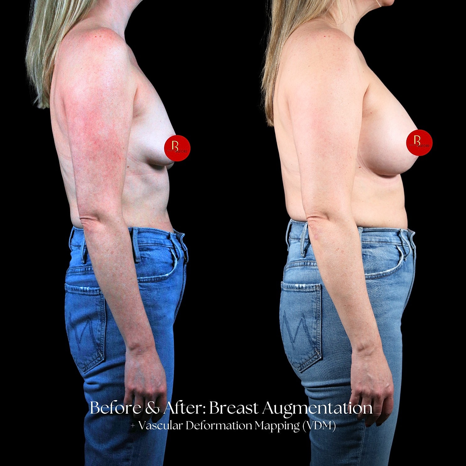 Breast Augmentation Before & After