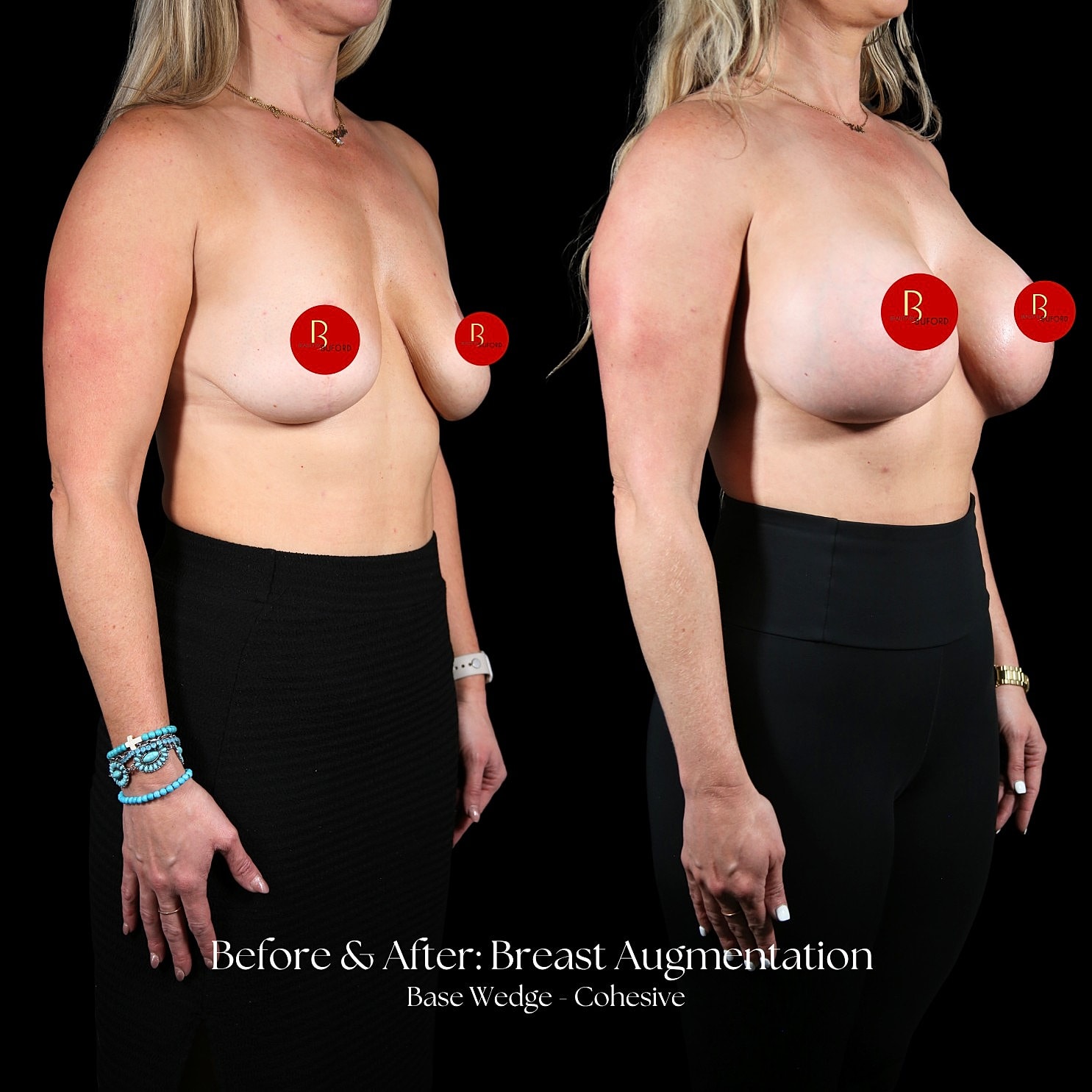 Breast Augmentation Before & After