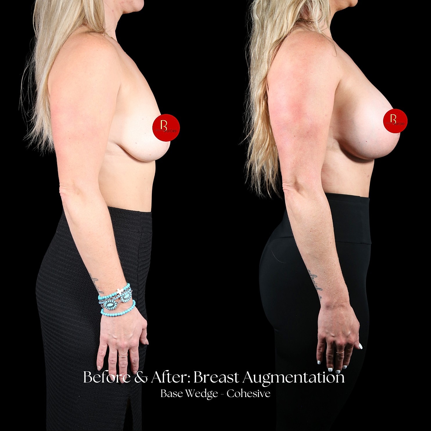 Breast Augmentation Before & After