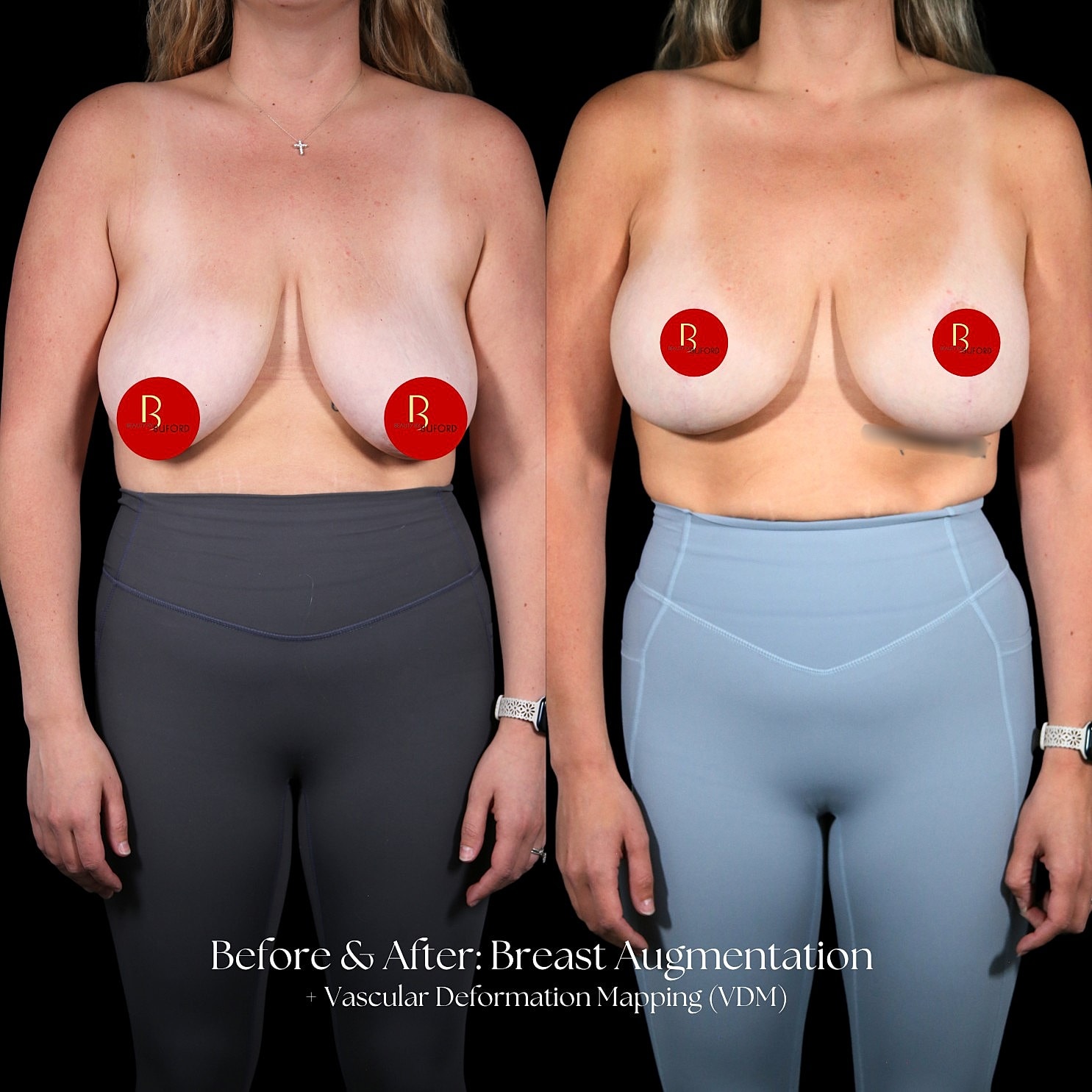Breast Augmentation Before & After