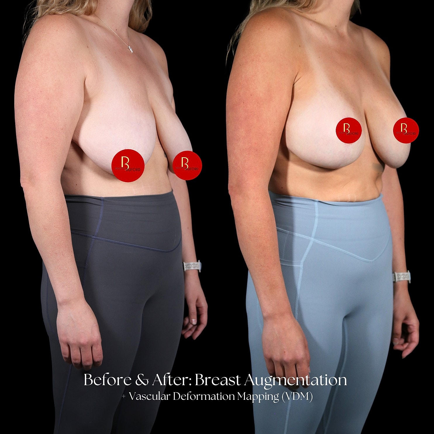 Breast Augmentation Before & After