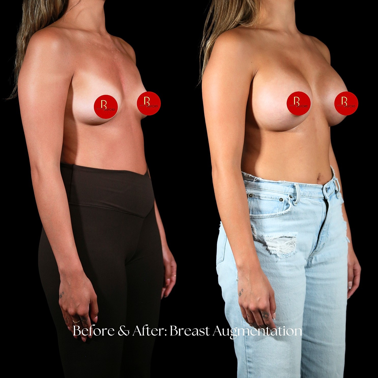 Breast Augmentation Before & After